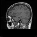 Amnestic syndrome secondary to hypoxic brain injury (Radiopaedia 24743-25004 T1 15).jpg