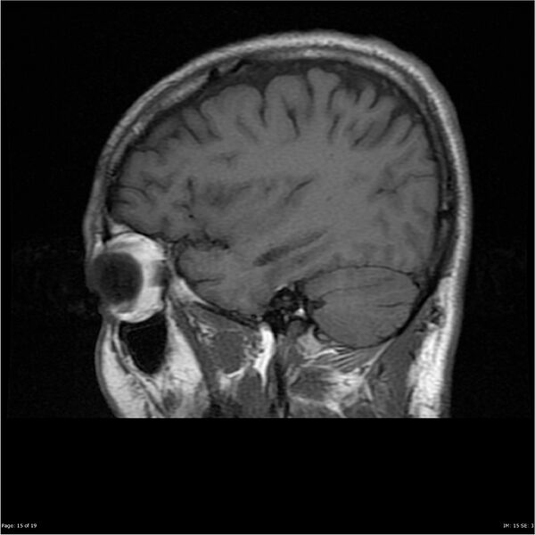 File:Amnestic syndrome secondary to hypoxic brain injury (Radiopaedia 24743-25004 T1 15).jpg