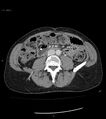 Ampulla of Vater metastasis (Radiopaedia 27820-28069 A 126).jpg
