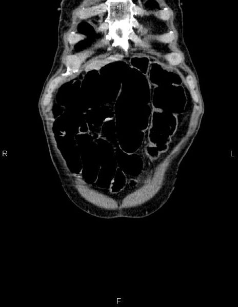File:Ampullary adenocarcinoma (Radiopaedia 86093-102032 C 2).jpg