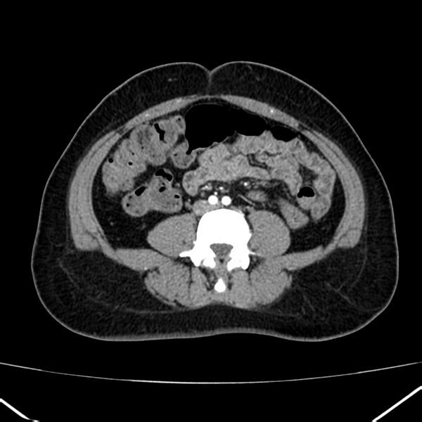 File:Ampullary tumor (Radiopaedia 22787-22816 B 56).jpg