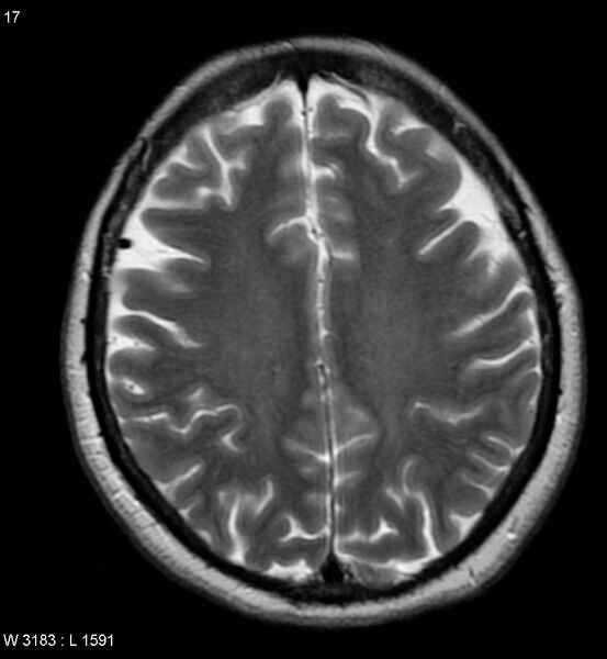 File:Amyotrophic lateral sclerosis (Radiopaedia 5373-7134 Axial T2 17).jpg