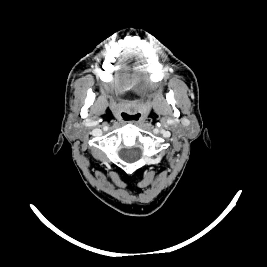 Anaplastic thyroid carcinoma (Radiopaedia 79087-92034 B 101).jpg