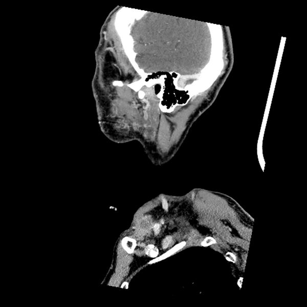 File:Anaplastic thyroid carcinoma (Radiopaedia 79087-92034 C 17).jpg
