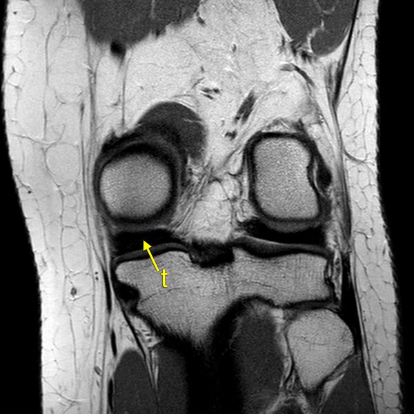 File:Anatomy Quiz (MRI knee) (Radiopaedia 43478-46874 A 22).jpeg