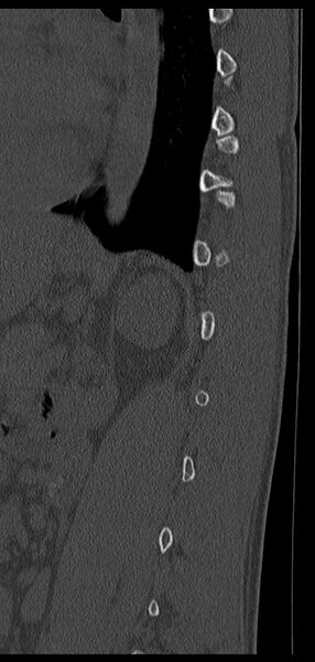 File:Aneurysmal bone cyst T11 (Radiopaedia 29294-29721 Sagittal bone window 19).jpg