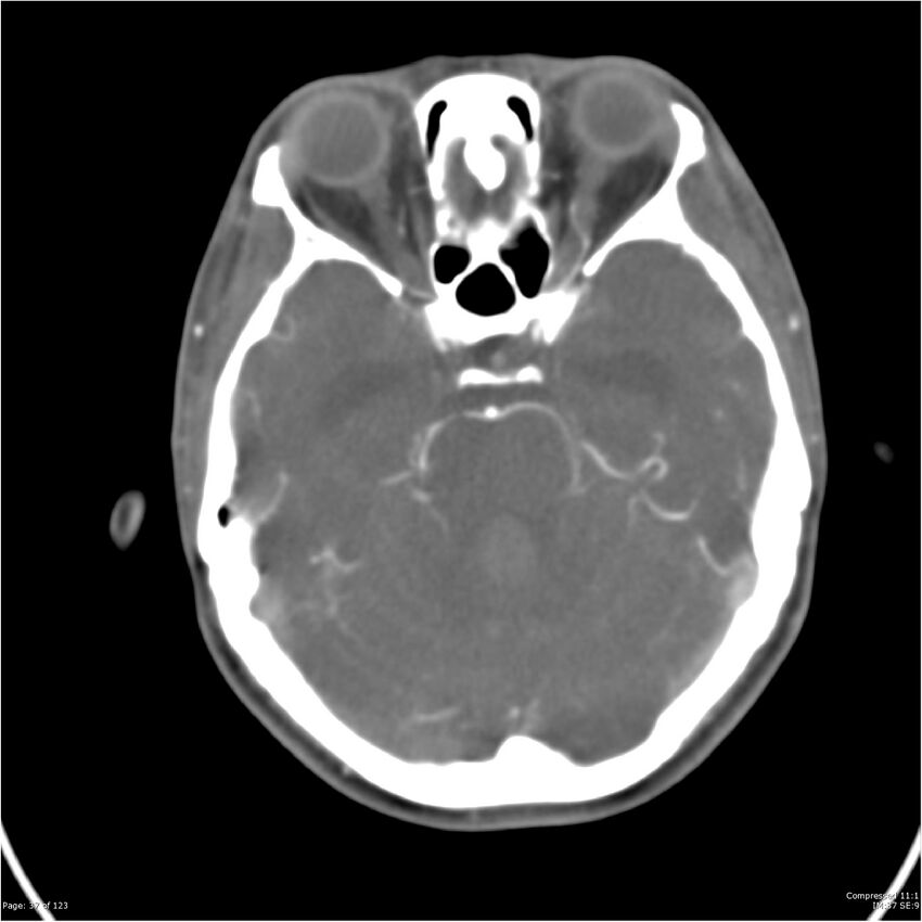 Aneurysmal subarachnoid hemorrhage and Moya Moya disease (Radiopaedia 34306-35593 Axial CT COW 37).jpg