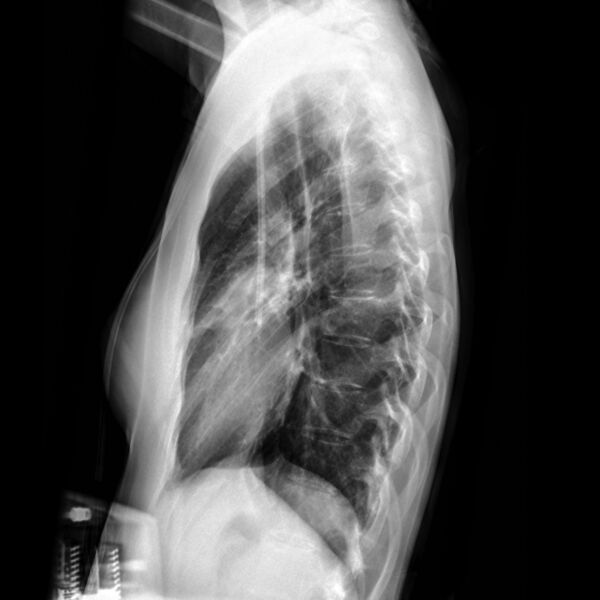 File:Angioinvasive aspergillosis (Radiopaedia 8651-15073 Lateral 1).jpg
