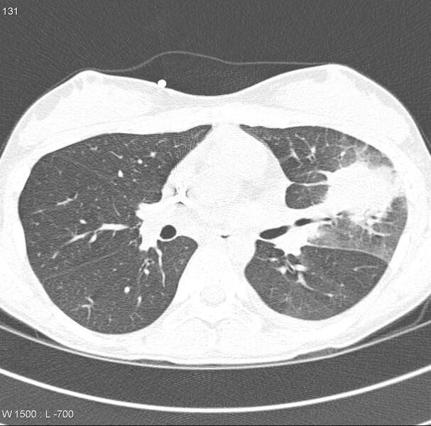 File:Angioinvasive aspergillosis (Radiopaedia 8651-9466 Axial lung window 5).jpg