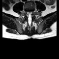 Ankylosing spondylitis with zygapophyseal arthritis (Radiopaedia 38433-40517 C 13).jpg