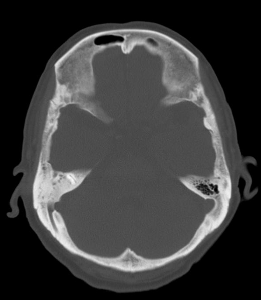 File:Anomalous intracranial venous drainage (Radiopaedia 28161-28418 Axial 4).png