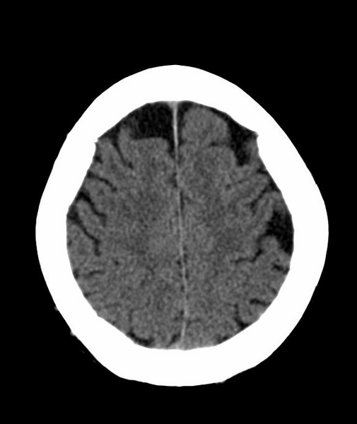 File:Anomalous intracranial venous drainage (Radiopaedia 28161-28418 Axial 44).png