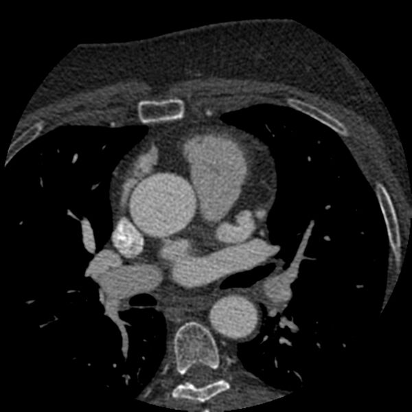 File:Anomalous origin of left circumflex artery from right coronary sinus (Radiopaedia 72563-83117 B 26).jpg