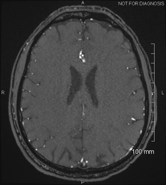 File:Anterior cerebral artery aneurysm (Radiopaedia 80683-94127 Axial MRA 164).jpg