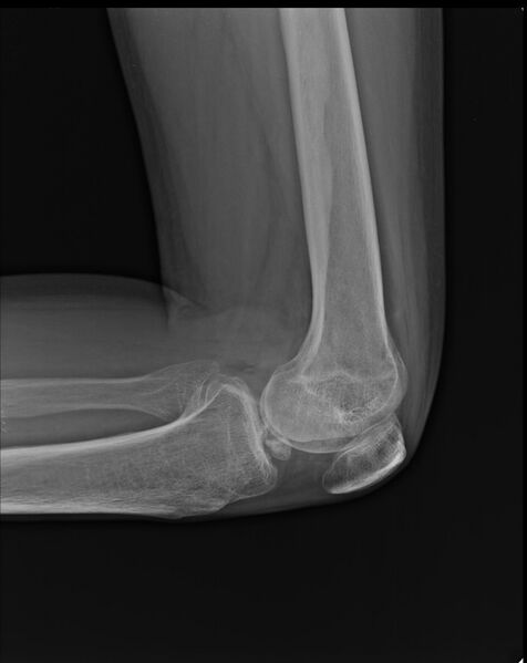 File:Anterior cruciate ligament bony avulsion (Radiopaedia 10903-11333 Lateral 1).jpg