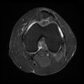 Anterior cruciate ligament tear, Wrisberg rip and bucket-handle tear of medial meniscus (Radiopaedia 75872-87266 Axial PD fat sat 15).jpg