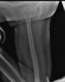 Anterior dislocation of shoulder (Radiopaedia 13397-13381 Lateral 1).jpg