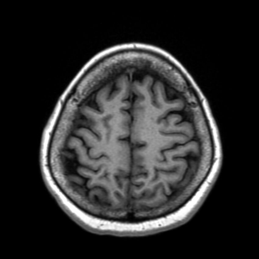 Anti-MOG encephalomyelitis (Radiopaedia 73831-84646 Axial T1 40).jpg