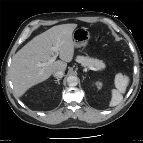 File:Aortic dissection- Stanford A (Radiopaedia 37759-39664 A 71).jpg