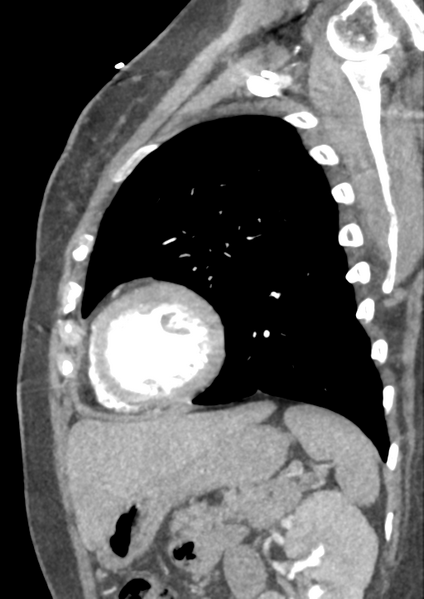 File:Aortic dissection - Stanford type B (Radiopaedia 50171-55512 C 3).png