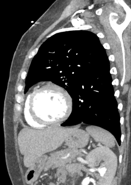File:Aortic dissection - Stanford type B (Radiopaedia 50171-55512 C 7).png