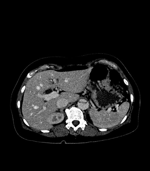 File:Aortic dissection with renal ischemia (Radiopaedia 76573-88338 B 25).jpg
