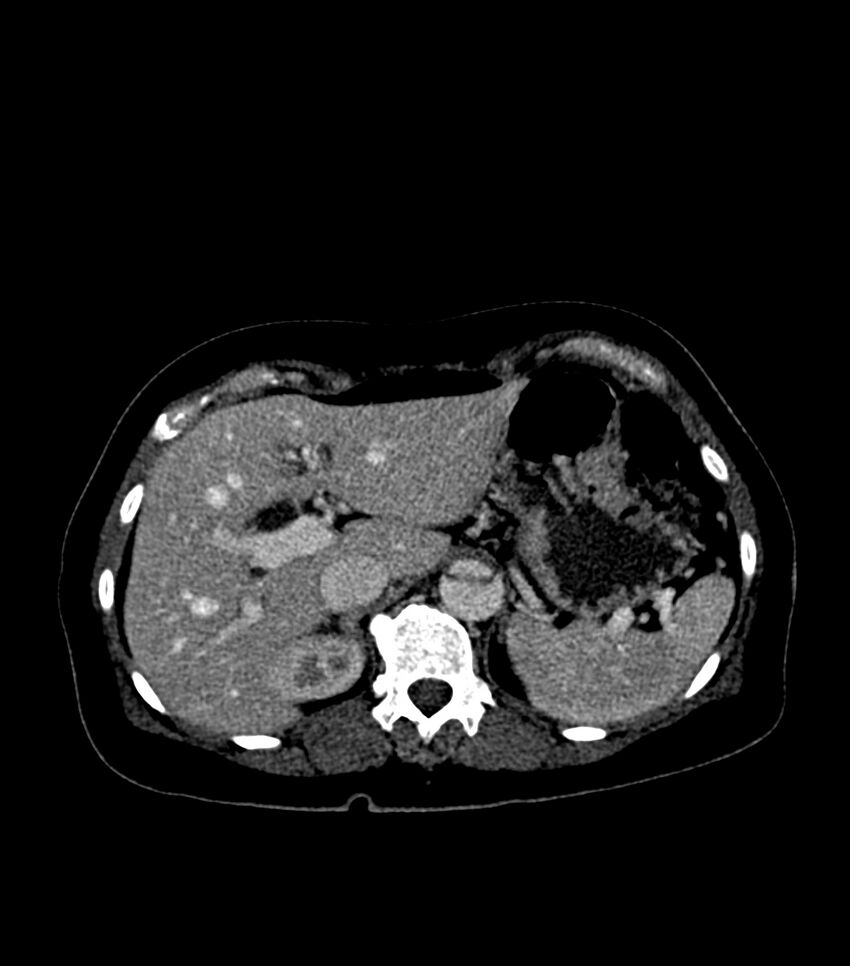 Aortic dissection with renal ischemia (Radiopaedia 76573-88338 B 25).jpg