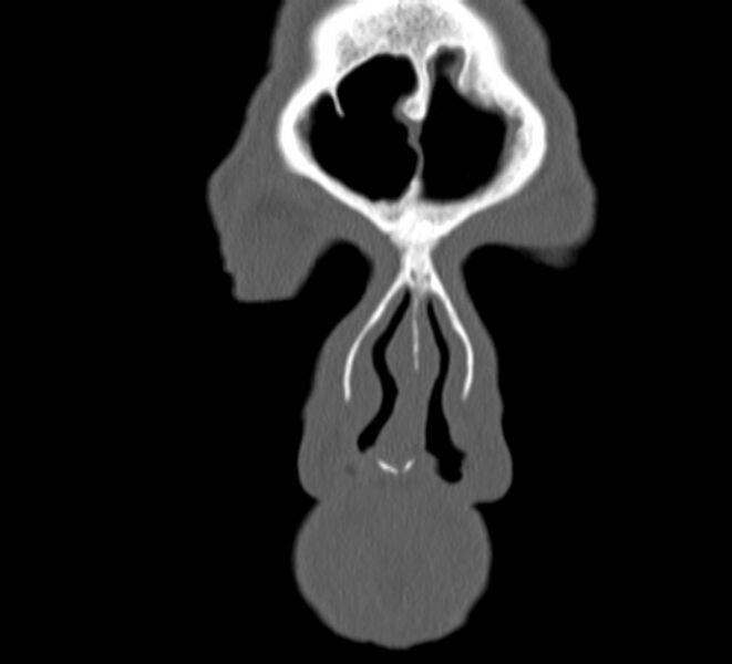File:Aplastic maxillary sinuses (Radiopaedia 60030-67561 Coronal non-contrast 4).jpg