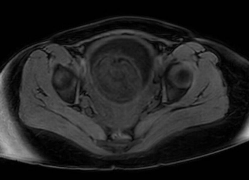 Appendicitis in gravida (MRI) (Radiopaedia 89433-106395 Axial DIXON 132).jpg