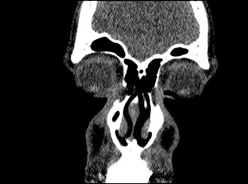 Arachnoid cyst- extremely large (Radiopaedia 68741-78450 Coronal bone window 68).jpg