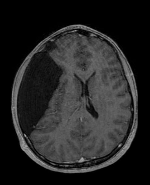 File:Arachnoid cyst- extremely large (Radiopaedia 68741-78451 Axial T1 C+ 49).jpg