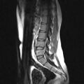 Arachnoid cyst - spinal (Radiopaedia 66835-76157 Sagittal T1 7).jpg