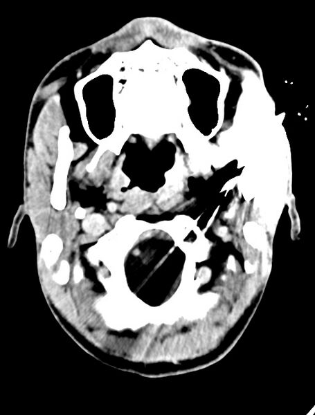 File:Arrow injury to the face (Radiopaedia 73267-84011 Axial C+ delayed 31).jpg