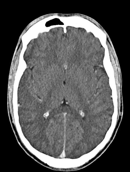 File:Arrow injury to the face (Radiopaedia 73267-84011 Axial C+ delayed 54).jpg