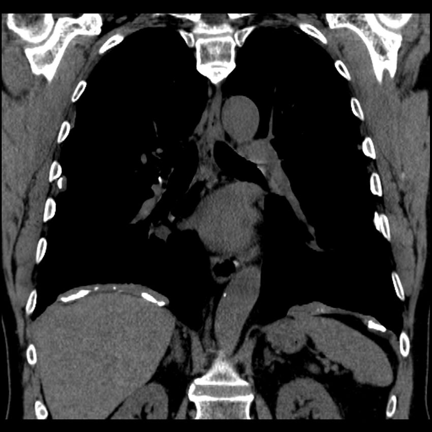 Asbestos-related pleural plaques (Radiopaedia 39069-41255 Coronal non-contrast 35).jpg