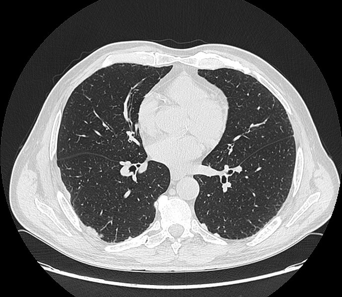 File:Asbestos pleural placques (Radiopaedia 57905-64872 Axial lung window 139).jpg