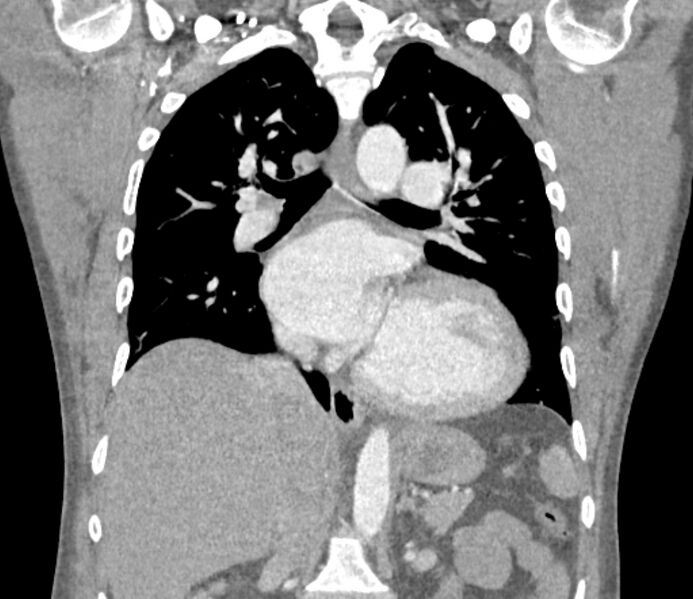 File:Ascending aortic aneurysm (Radiopaedia 86279-102297 B 38).jpg