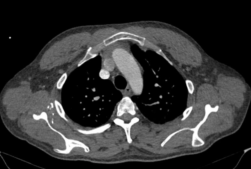 File:Ascending aortic aneurysm (Radiopaedia 86279-102297 C 12).jpg