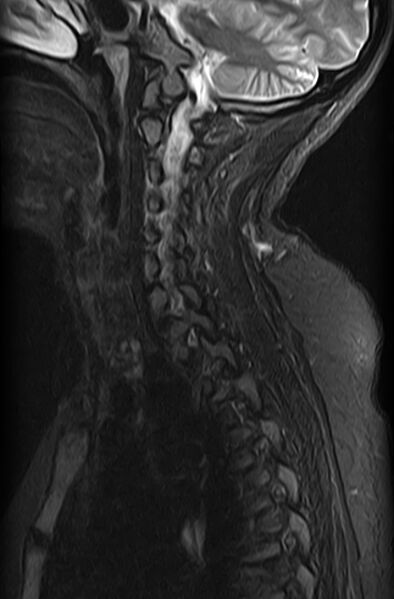 File:Astrocytoma - spinal cord (Radiopaedia 69769-79758 Sagittal STIR 4).jpg