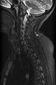 Astrocytoma - spinal cord (Radiopaedia 69769-79758 Sagittal STIR 4).jpg