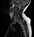 Astrocytoma - spinal cord (Radiopaedia 69769-79758 Sagittal T2 11).jpg