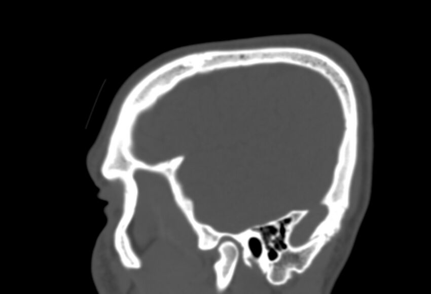 Asymptomatic occipital spur (Radiopaedia 87753-104201 Sagittal bone window 39).jpg
