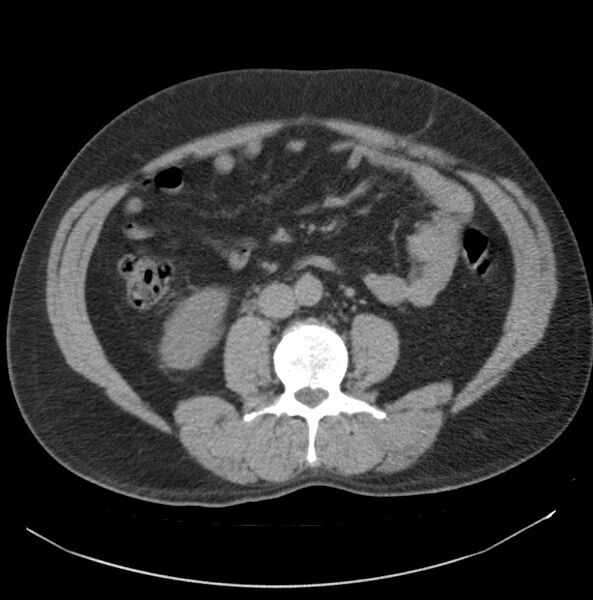 File:Atrophic kidney due to severe chronic obstructive hydronephrosis (Radiopaedia 40828-43474 Axial non-contrast 14).jpg