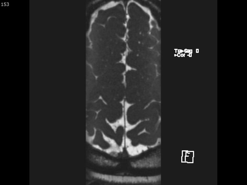 File:Atypical meningioma - intraosseous (Radiopaedia 64915-74572 Axial CISS 153).jpg