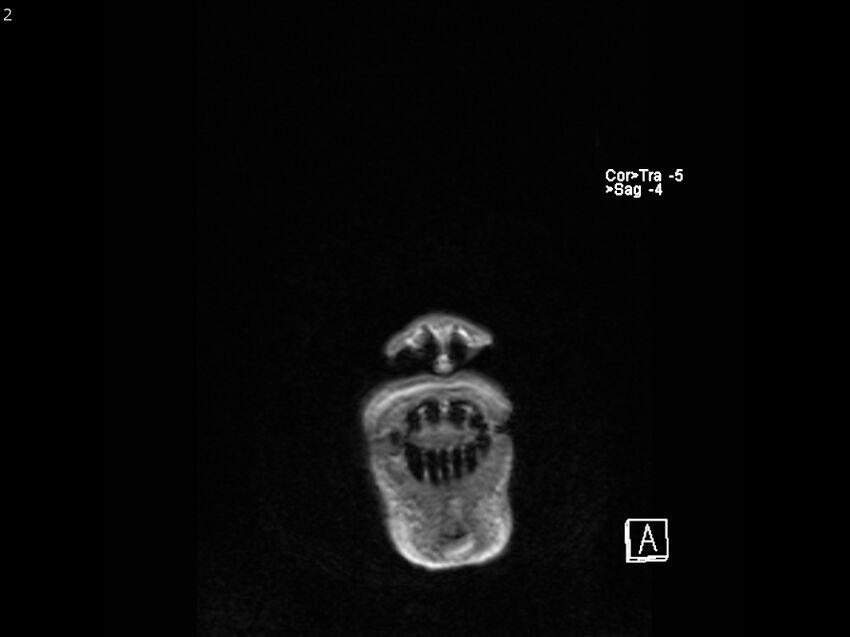 Atypical meningioma - intraosseous (Radiopaedia 64915-74572 Coronal T1 2).jpg