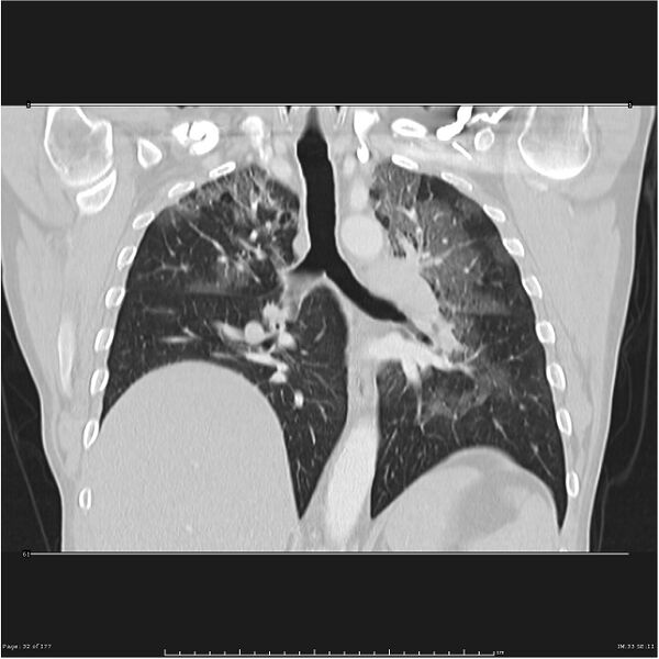 File:Atypical pneumonia - Q fever (Radiopaedia 21993-21989 C 25).jpg