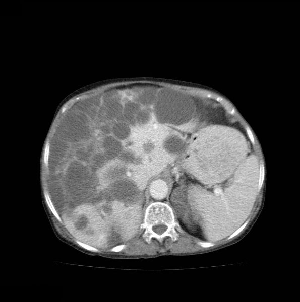 File:Autosomal dominant polycystic kidney disease (Radiopaedia 16777-16490 A 15).jpg