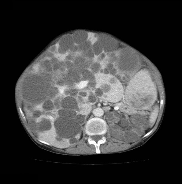 File:Autosomal dominant polycystic kidney disease (Radiopaedia 16777-16490 A 22).jpg