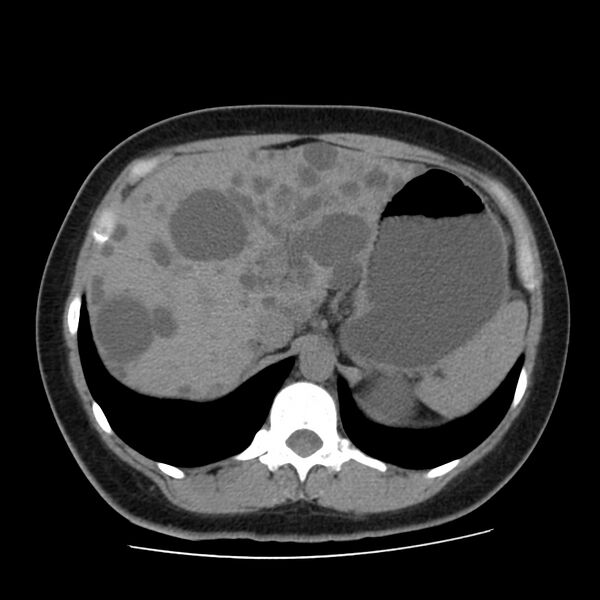 File:Autosomal dominant polycystic kidney disease (Radiopaedia 23061-23093 Axial non-contrast 14).jpg