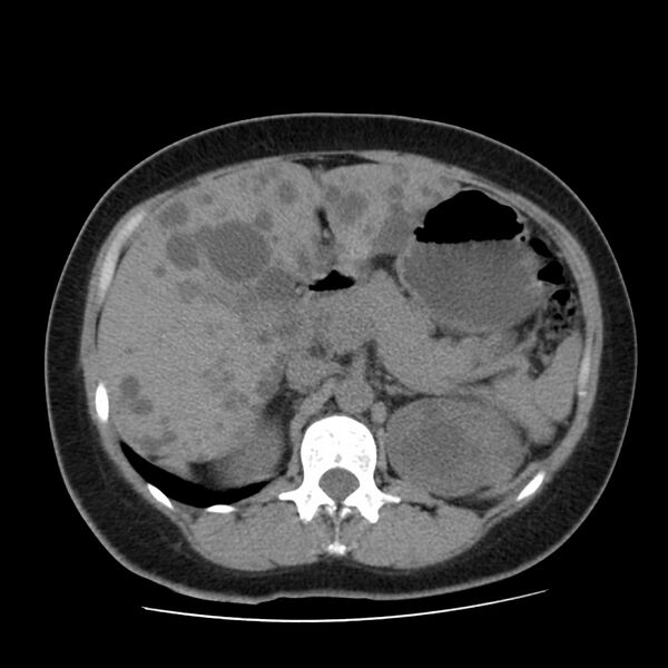 File:Autosomal dominant polycystic kidney disease (Radiopaedia 23061-23093 Axial non-contrast 19).jpg